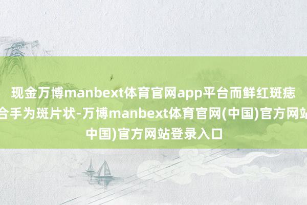 现金万博manbext体育官网app平台而鲜红斑痣则频频保合手为斑片状-万博manbext体育官网(中国)官方网站登录入口